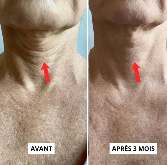 Kit de soin Micro-infusion