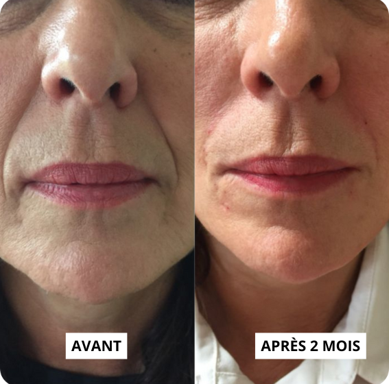 Kit de soin Micro-infusion