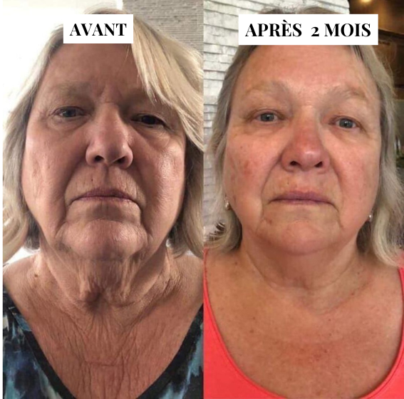 Kit de soin Micro-infusion
