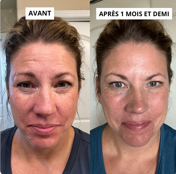 Kit de soin Micro-infusion