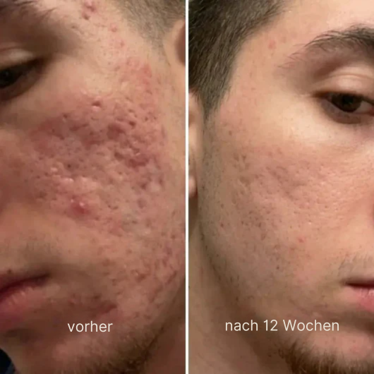 Klinischer Akne-Narben-Reparaturstift